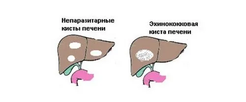 як лікувати кісту печінки