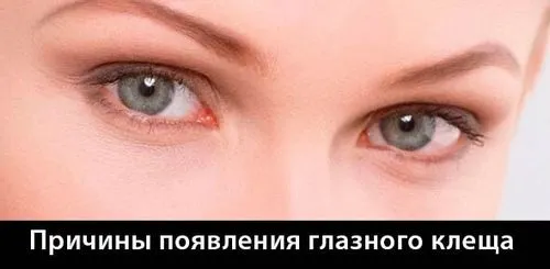 як лікувати демодекс на віях