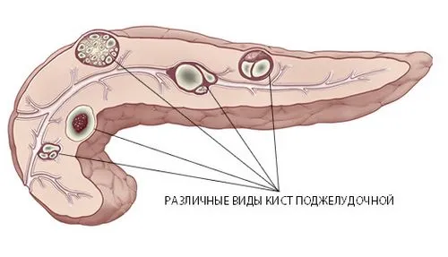 як лікувати кісту підшлункової залози