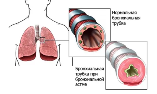 вилікувати астму дихальною гімнастикою