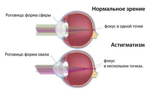 як вилікувати астигматизм народними засобами