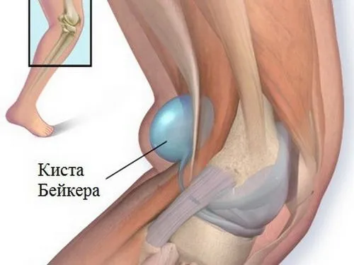 як лікувати кісту в коліні