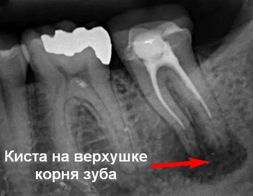як лікувати кісту кореня зуба