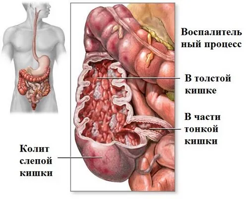 як лікувати коліт кишечника