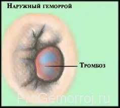 лікувати зовнішній геморой