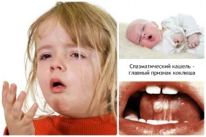 як лікувати коклюш у дитини
