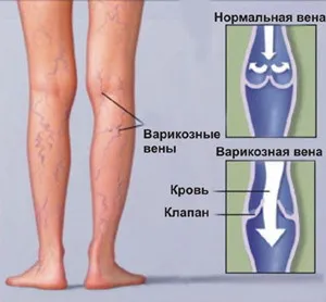Лікування варикозу перекисом як лікувати варикоз перекисом водню
