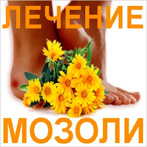 лікування мозолів на ногах