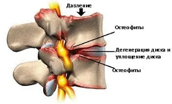 як вилікувати спину народними засобами