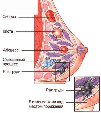 можна лікувати мастопатію п'явками