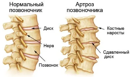 як вилікувати спину народними засобами