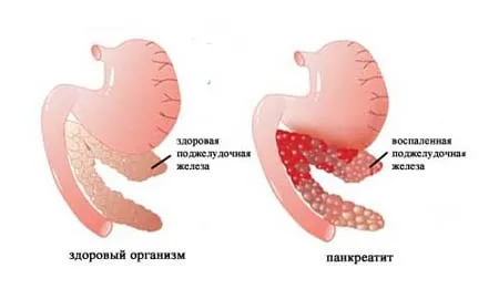 лікувати кісту підшлункової залози