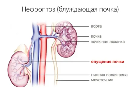 як лікувати нефроптоз нирки