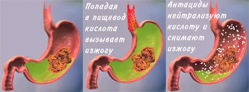 як лікувати шлунок при годуванні груддю