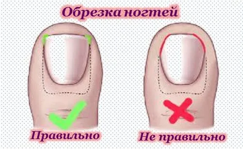 як вилікувати хворий ніготь на нозі