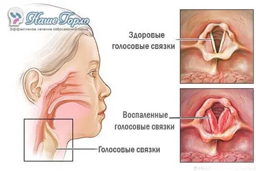 лікувати ларингіт дорослих