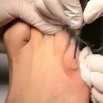 як лікувати мозоль з коренем