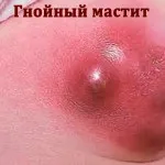 як лікувати мастит у дітей