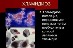 Чи можна вилікувати хламідіоз стоп ЗПСШ