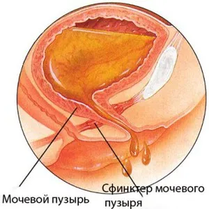 нетримання сечі у жінок причини