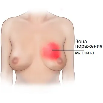 як лікувати інфільтративний мастит