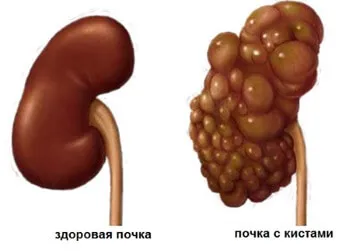 як вилікувати мультикистоз нирки