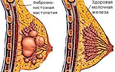 Містить у годуючих мам: як вилікувати? як вилікувати мастит на ранній стадії