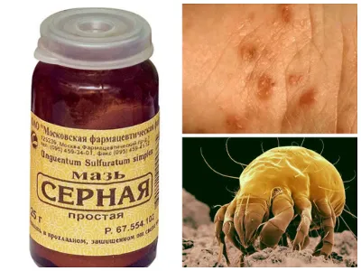 як лікувати коросту сірчаної маззю