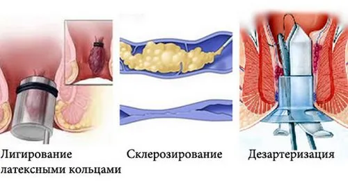 геморой можна вилікувати назавжди