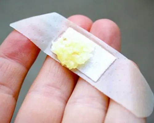 як лікувати папіломи при вагітності