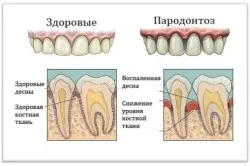Опущення ясен: лікування як лікувати сіли ясна