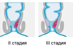 Масло обліпихи при геморої як лікувати геморой маслом обліпихи