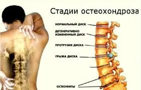 як лікувати остеохондроз другого ступеня