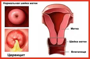 цервицита шийки матки лікування