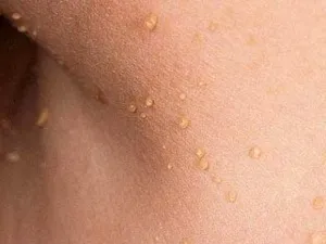 як лікувати плоскі папіломи