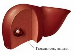 як лікувати порушення відтоку жовчі