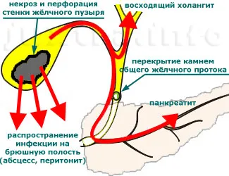 як лікувати порушення відтоку жовчі