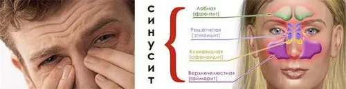 як і чим лікувати синусит