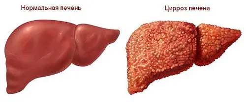 носій гепатиту б як лікувати