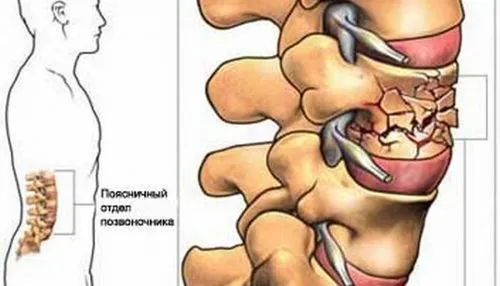 ніж лікувати остеопороз хребта