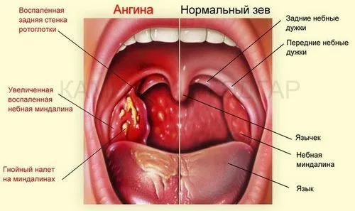 як лікувати ревматизм після ангіни