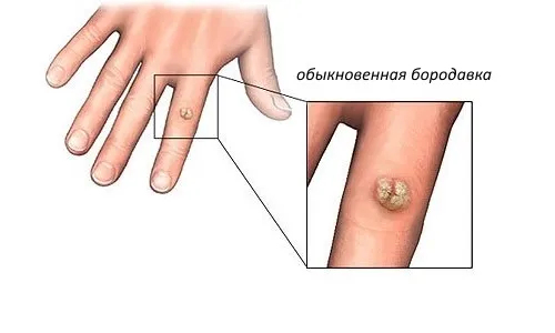 як лікувати плоскі бородавки у дитини