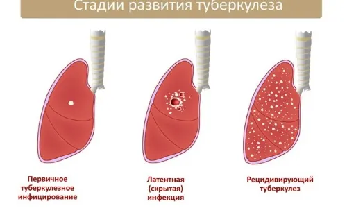 Вогнищевий туберкульоз легень: причини, симптоми, лікування, як передається, заразність як лікувати вогнищевий туберкульоз легенів