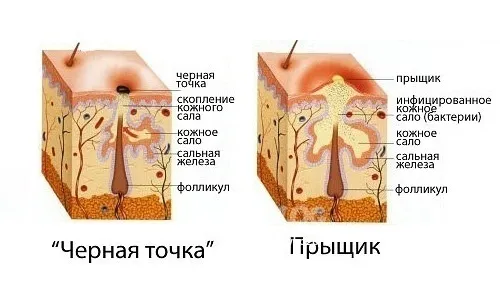 як лікувати прищі на щоках в домашніх умовах