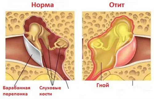як лікувати отит у дитини в домашніх умовах
