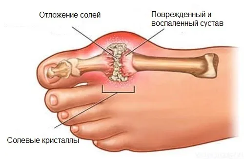 як лікувати суглоби ніг народними засобами