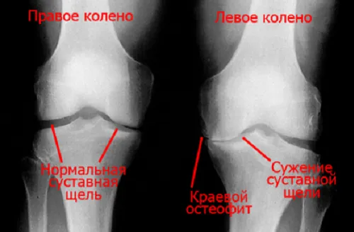 як лікувати суглоби ніг народними засобами