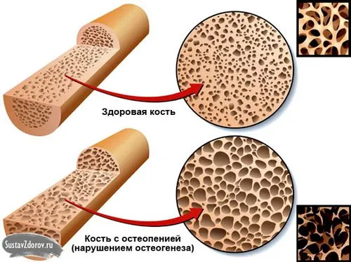 як лікувати остеопороз стегна