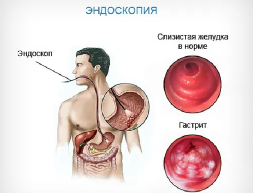 гострий гастрит симптоми
