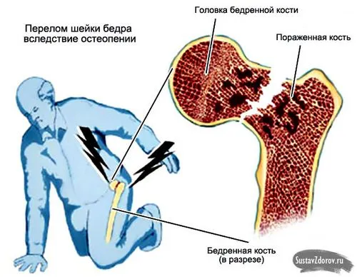 як лікувати остеопороз стегна